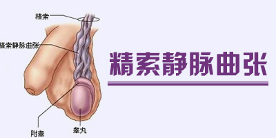 精索静脉曲张